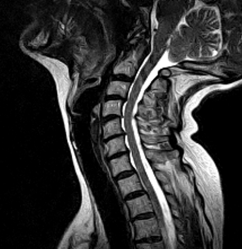 Cervical Spine VariPOSE MRI scan